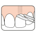 TePe Bridge & Implant Floss zubní nit, 30ks