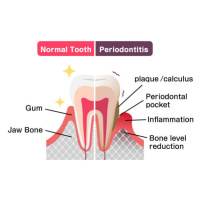 Fotografie Comparison of normal teeth and periodontal, Barks_japan, 40 × 30 cm