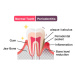 Fotografie Comparison of normal teeth and periodontal, Barks_japan, 40 × 30 cm